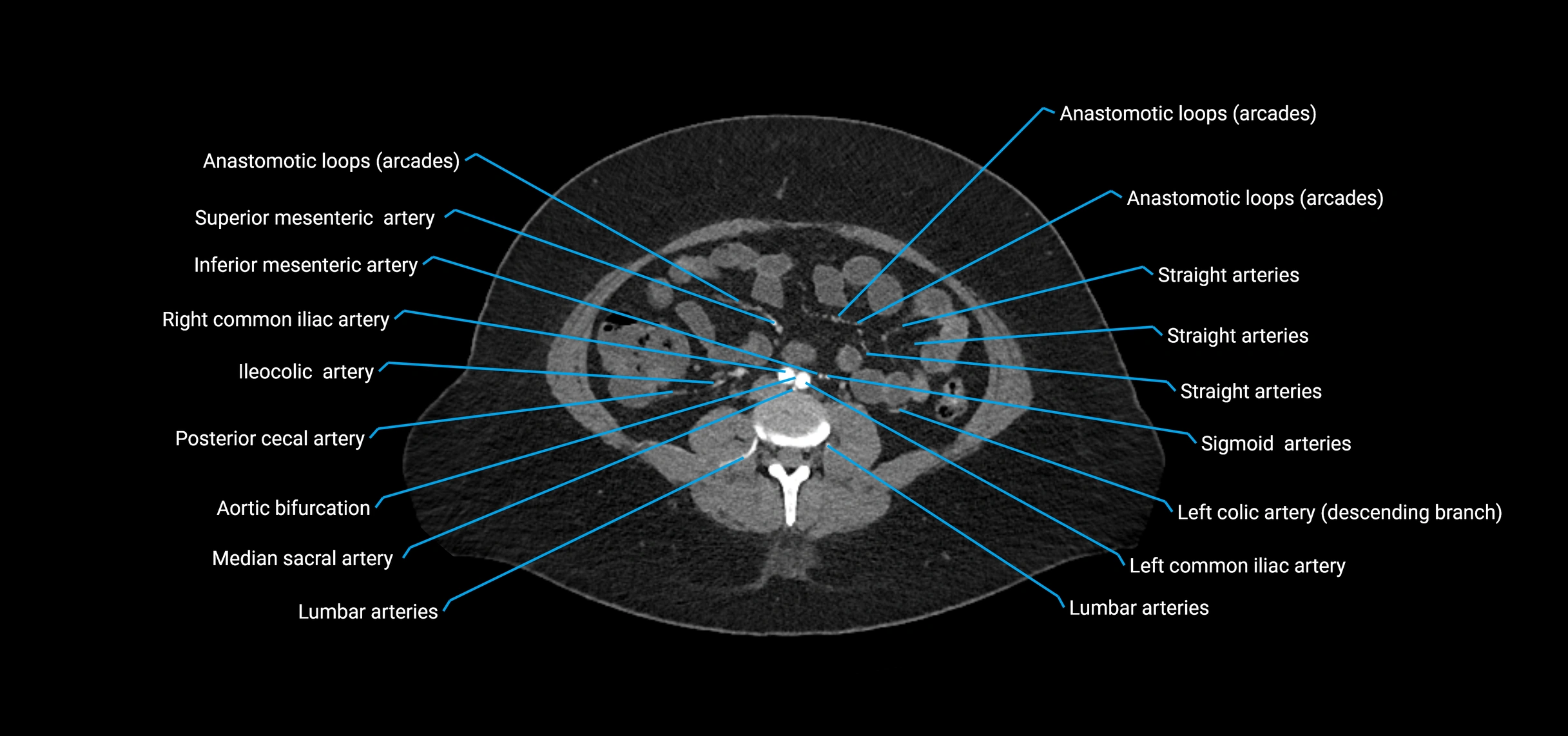 CTA abdomen axial cross sectional anatomy labelled image_125 (2).webp